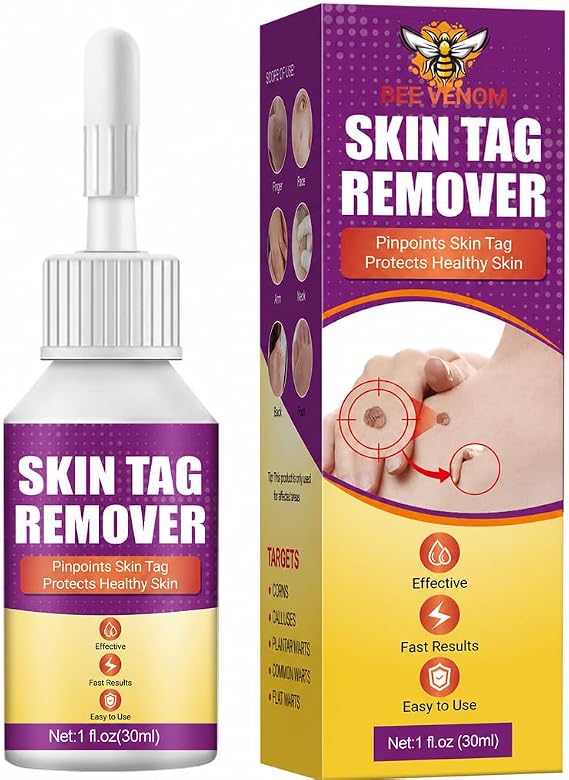 Wart Remover Skin Tag Removal for All Warts Verruca Treatment 30ml