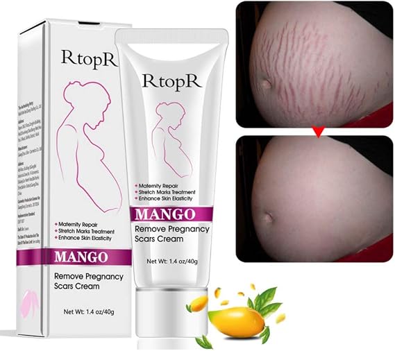 Stretch Mark Cream, Remove Pregnancy Scars, Treatment of Stretch Marks, Maternity Repair, Remove Stretch Marks of Pregnancy, 40g